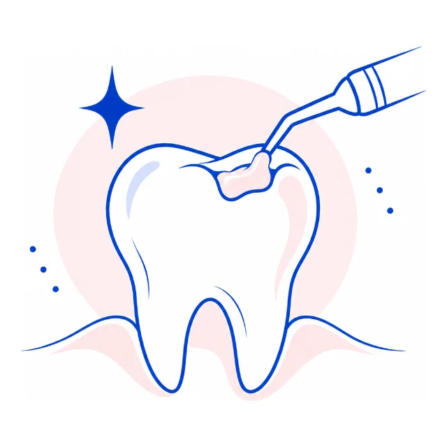 Line illustration of a molar receiving a tooth-colored filling