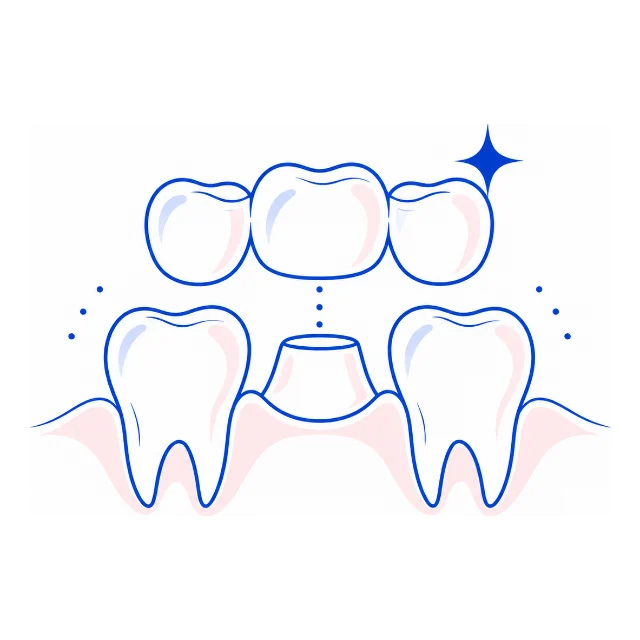 Line illustration of a three-unit bridge fitting over a prepared tooth