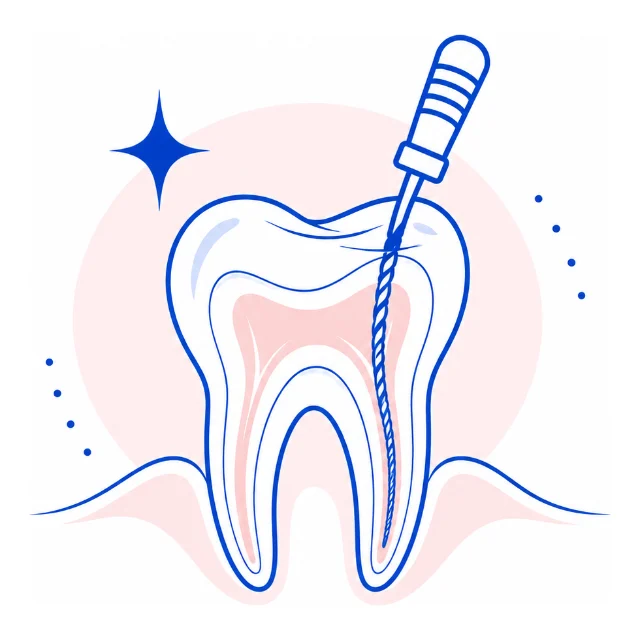 Line illustration of a root canal file inside a molar