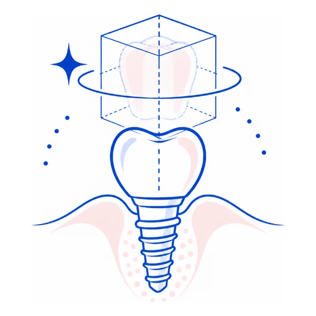 Line illustration of a dental implant with a digitally planned crown